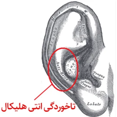 سن مناسب عمل اتوپلاستی